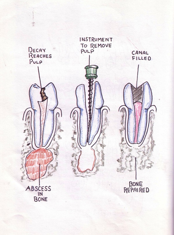 bone abscess in tooth
